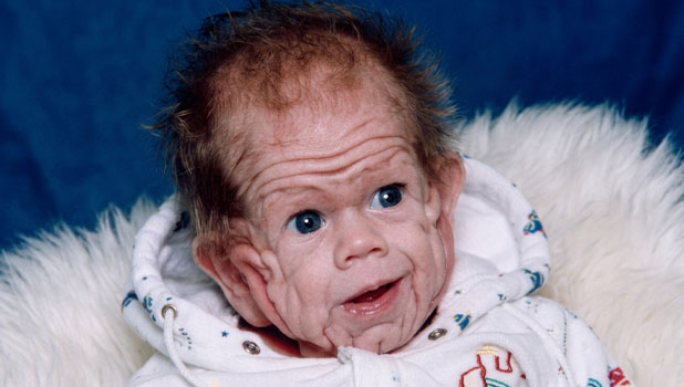 His mom was slammed and people told her that her wrinkled baby "should be kept hidden" — but today, he