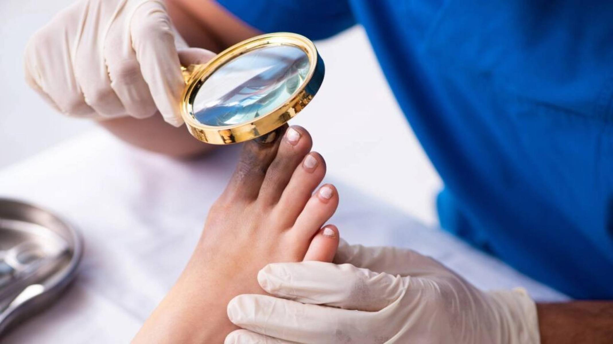 Fungos nas unhas dos pés: tratamentos caseiros que podem ajudar