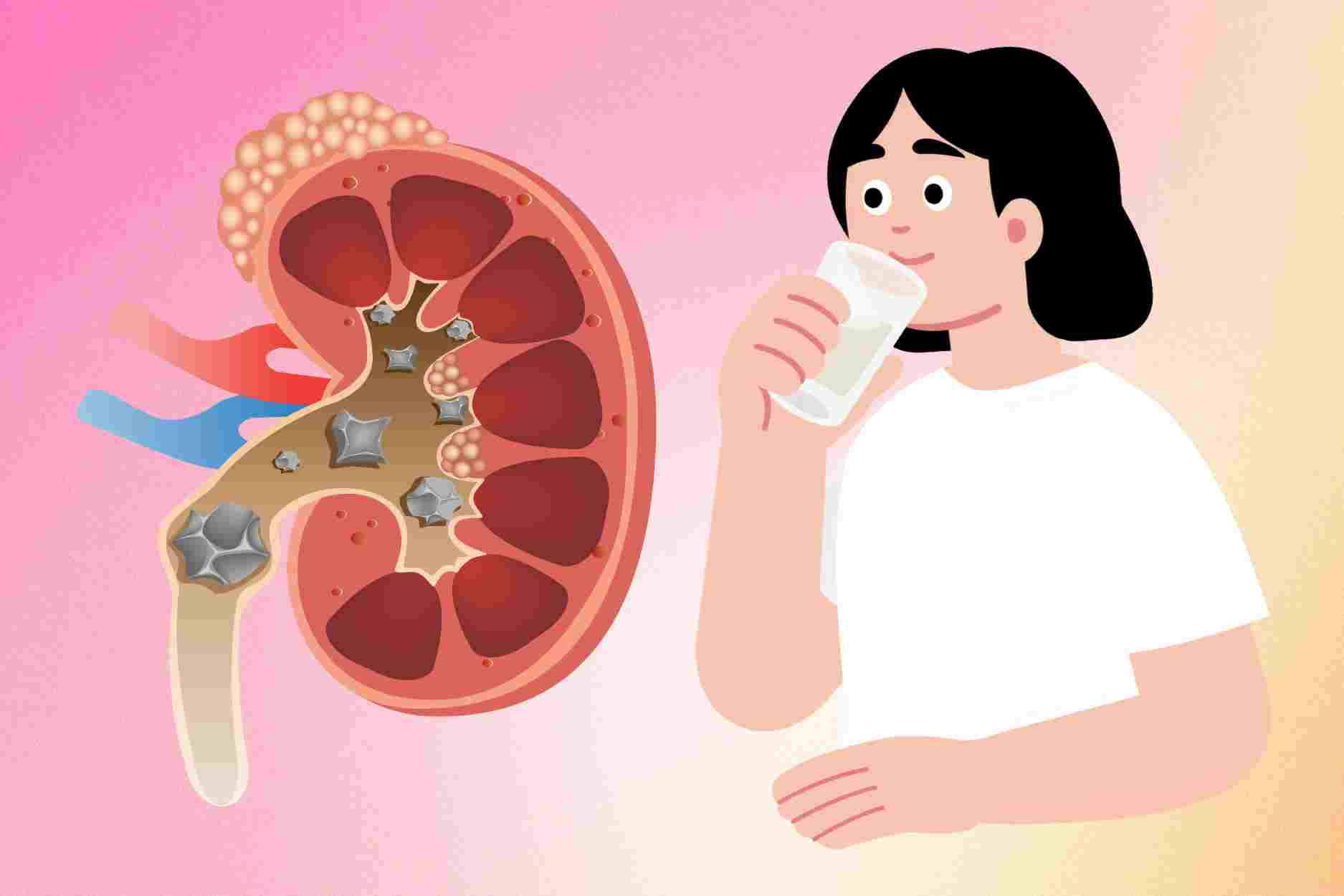 2 sai lầm khi uống nước làm tăng nguy cơ sỏi thận