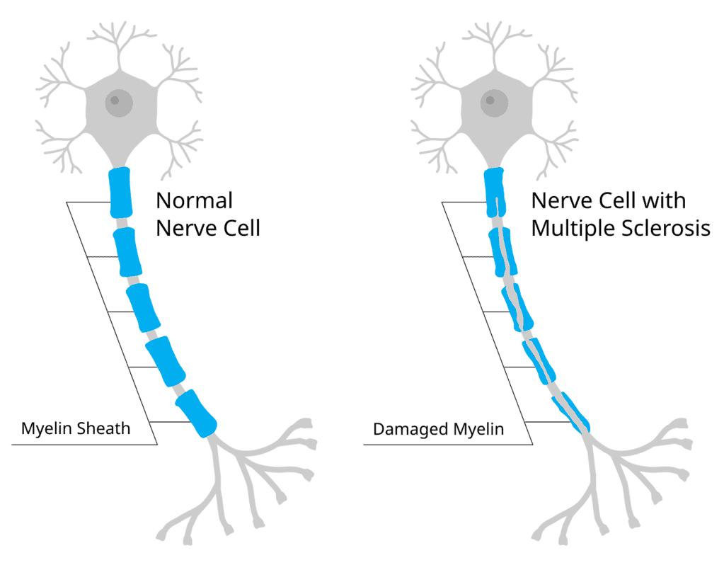 This common virus might be driving multiple sclerosis from inside the brain