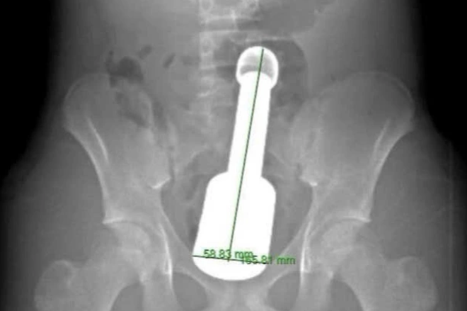 Thiếu niên 15 tuổi cấp cứu vì chiếc chày 18cm mắc kẹt ở hậu môn