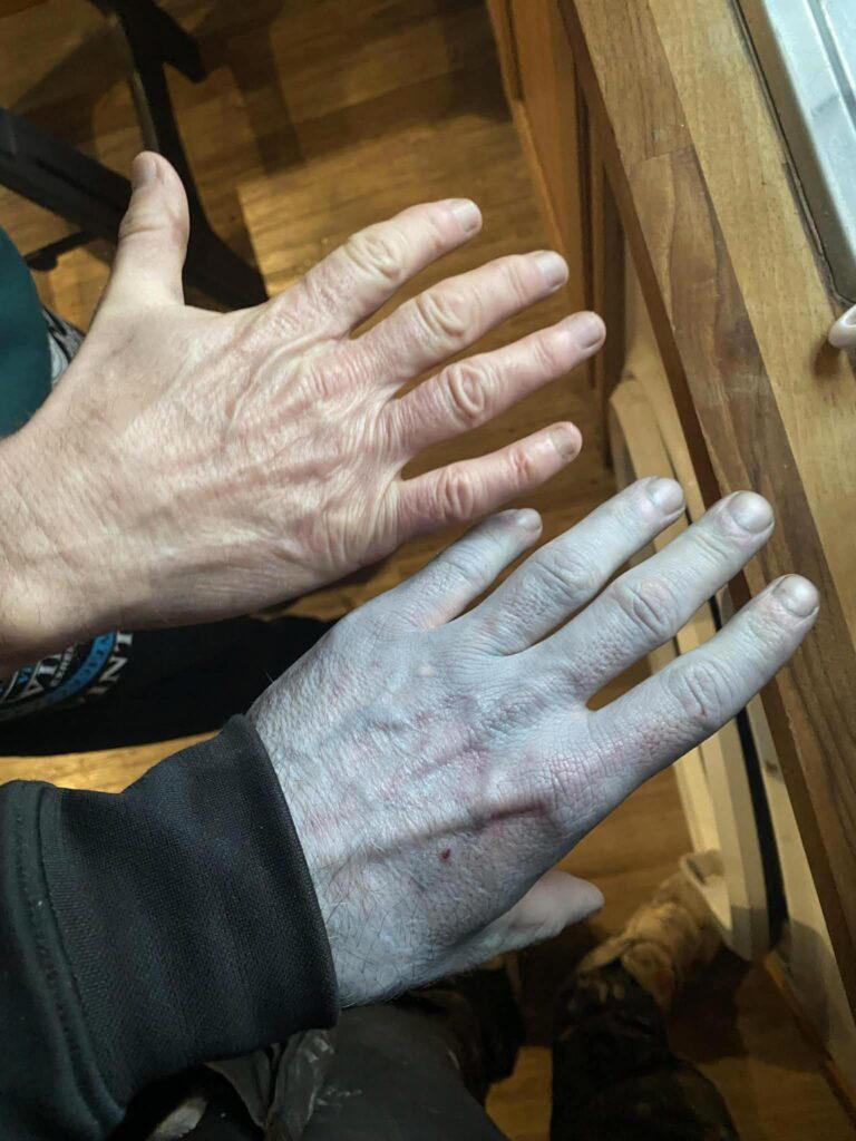 Man rushed to hospital after turning blue only to discover it’s dye ...