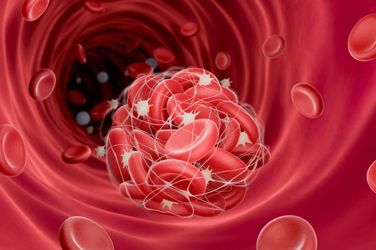 Blood clot symptoms as BBC doctor warns of signs you need immediate help