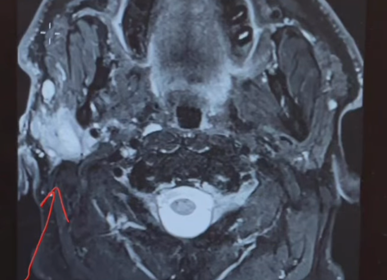 A scan showing the cancer in Jones' neck.