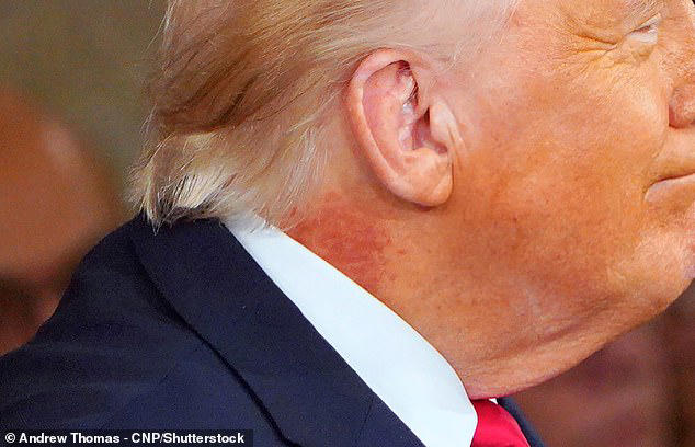 Trump sparks new health fears as viewers spot 'nasty' issue on his neck