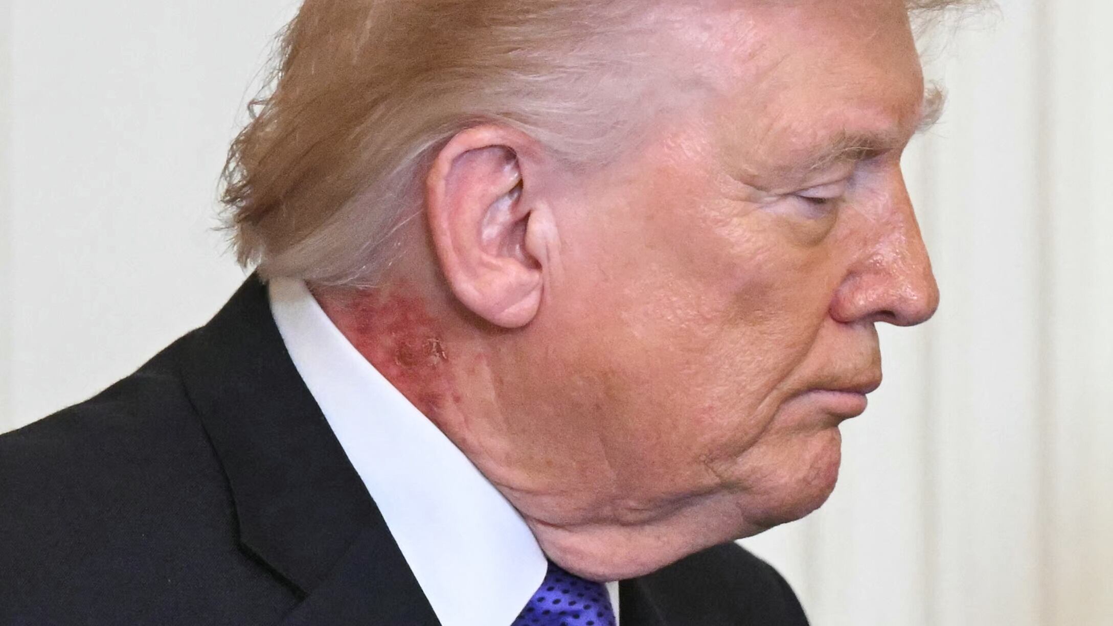 MAGA melts down over 79-year-old Trump’s bizarre new ailment
