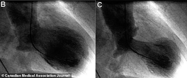 Rare condition that mimics a heart attack can strike even the ...