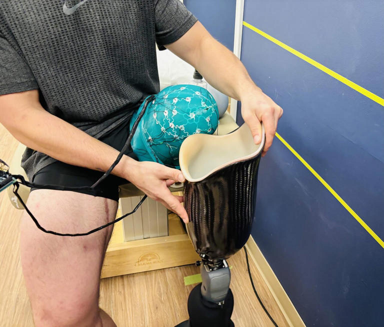 Novel prosthetic design combines AI and 3D printing to improve fit