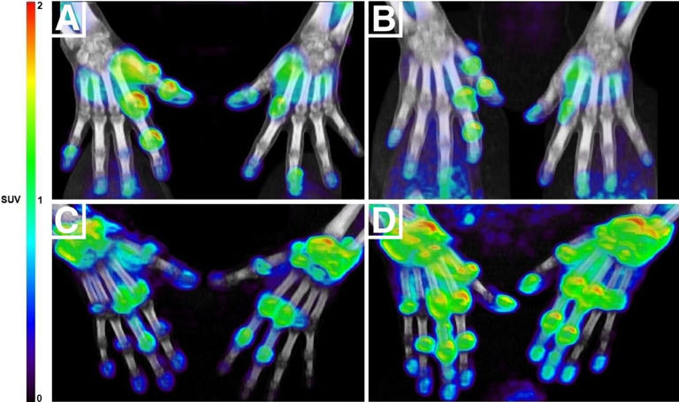 Targeted PET/CT predicts early treatment response in rheumatoid ...