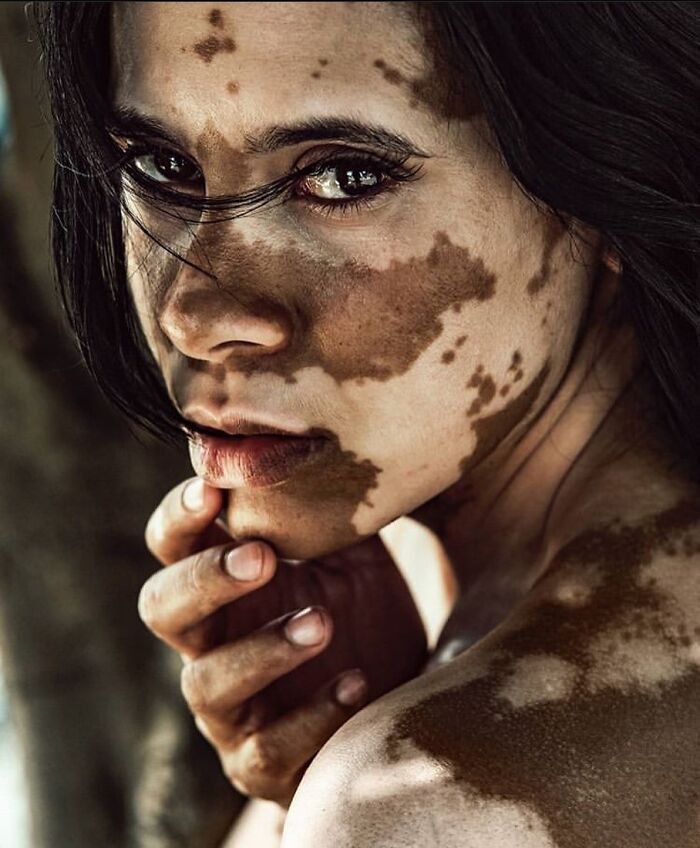 27-photos-showing-the-beauty-of-people-with-vitiligo