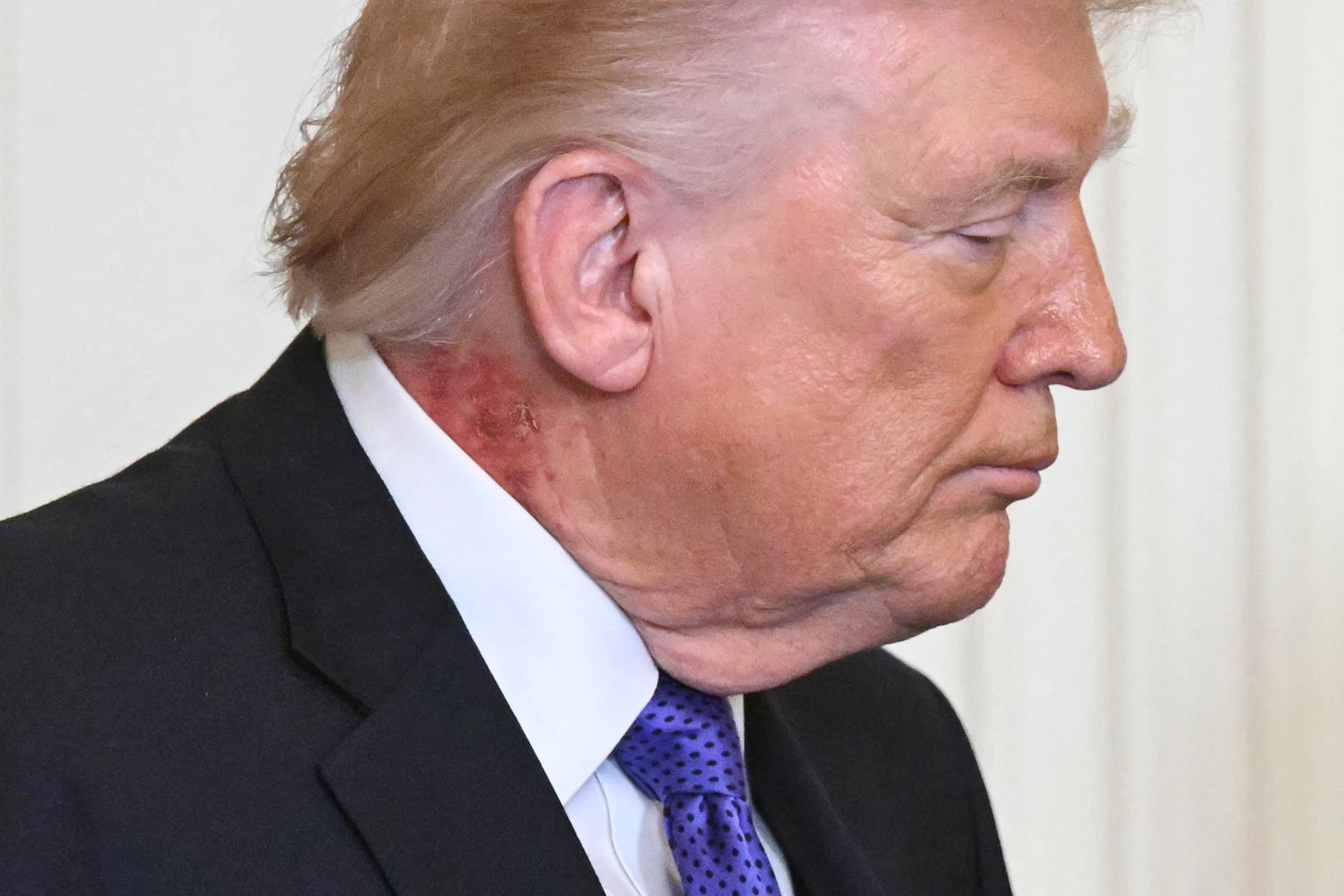 Images show rash on President Trump's neck. What is it?