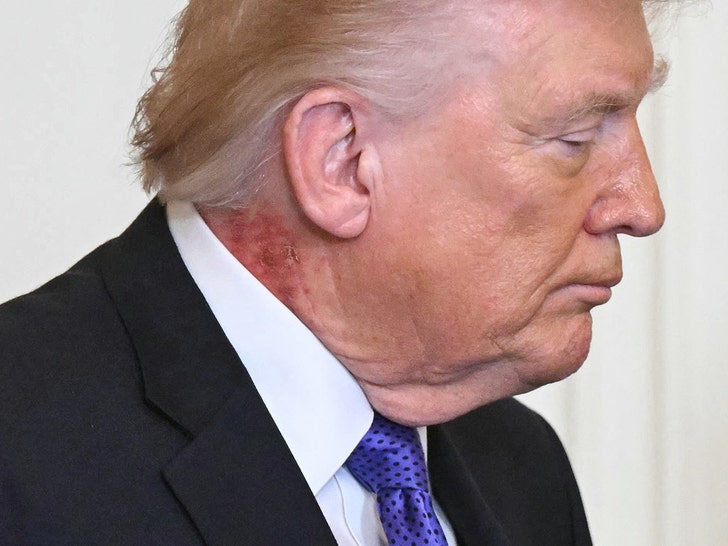 Nasty rash seen on President Trump's neck at White House press conference
