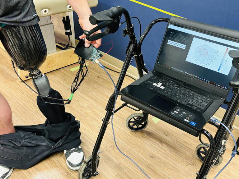 Novel prosthetic design combines AI and 3D printing to improve fit