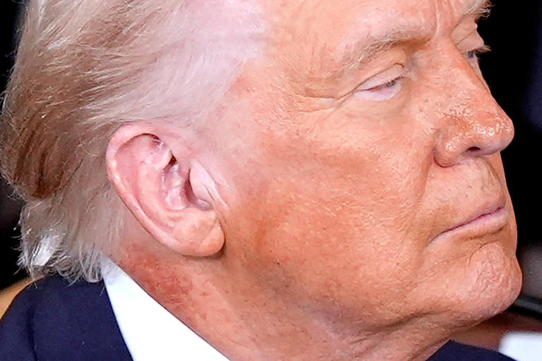 White House attributes redness on Trump's neck to skin cream but doesn ...