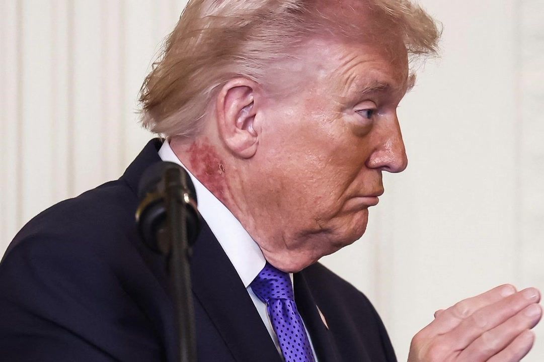 CNN doctor raises questions as Donald Trump is spotted with rash on his ...