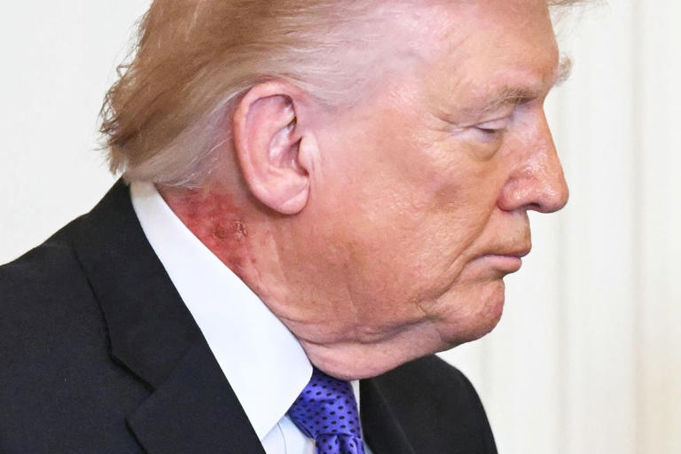 Trump appears to cover scabbing neck rash with makeup one day after it ...