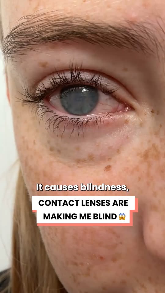 Contact lenses are making me blind