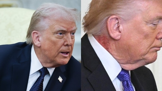 Trump 'rash': New photos spark cover-up allegations amid health ...