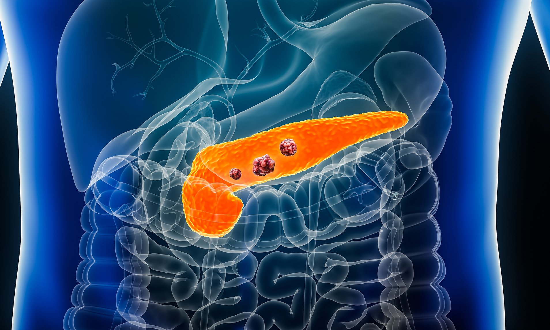 Hope for earlier detection of pancreatic cancer as experts uncover