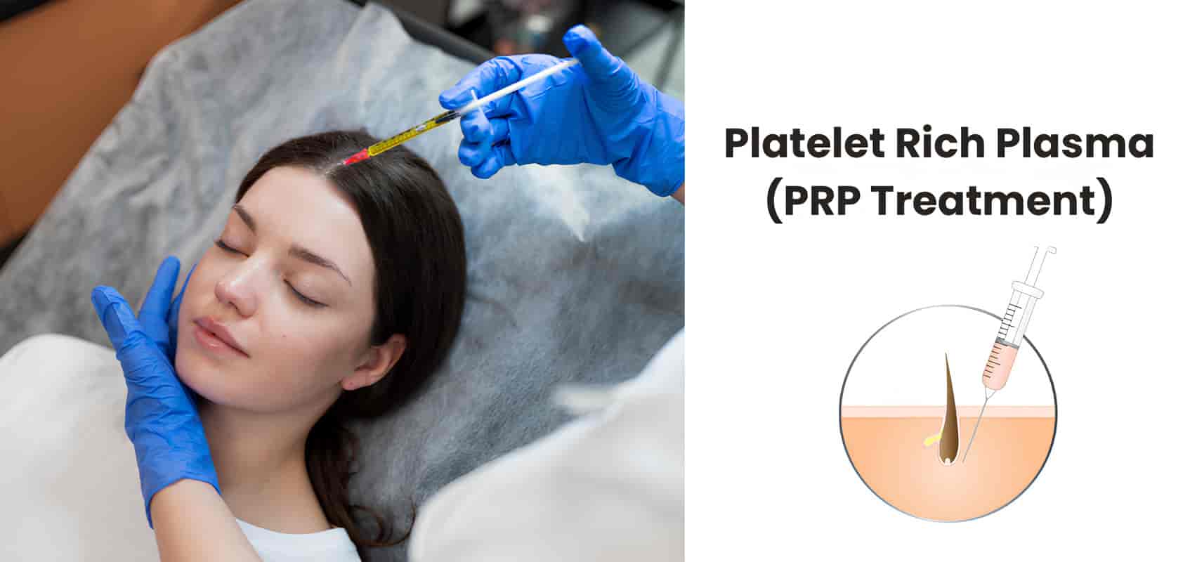 Platelet rich plasma (PRP treatment): A step-by-step guide