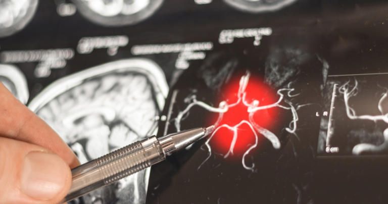 Alzheimer : un nouveau test sanguin détecte la maladie plus tôt grâce à ...