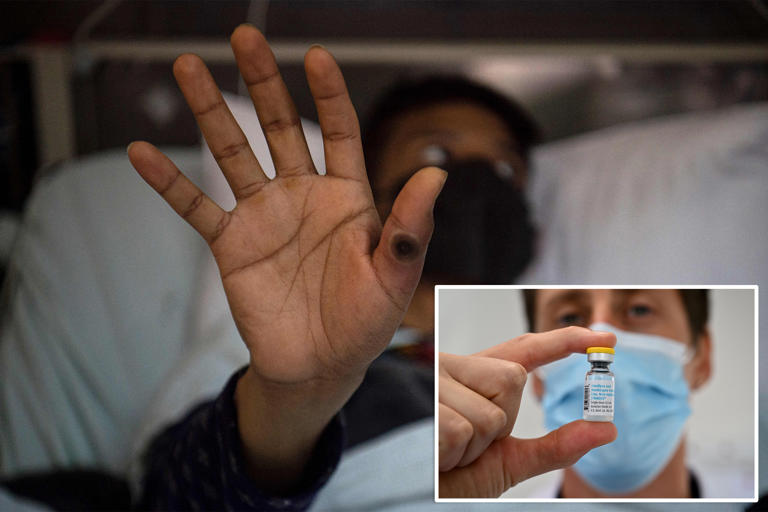 First known case of severe MPOX virus strain detected in NYC