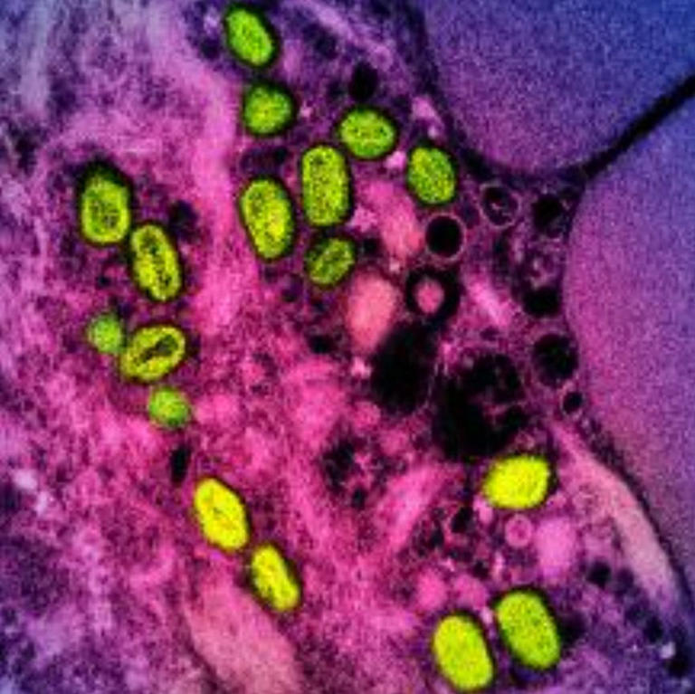 First known case of severe MPOX virus strain detected in NYC