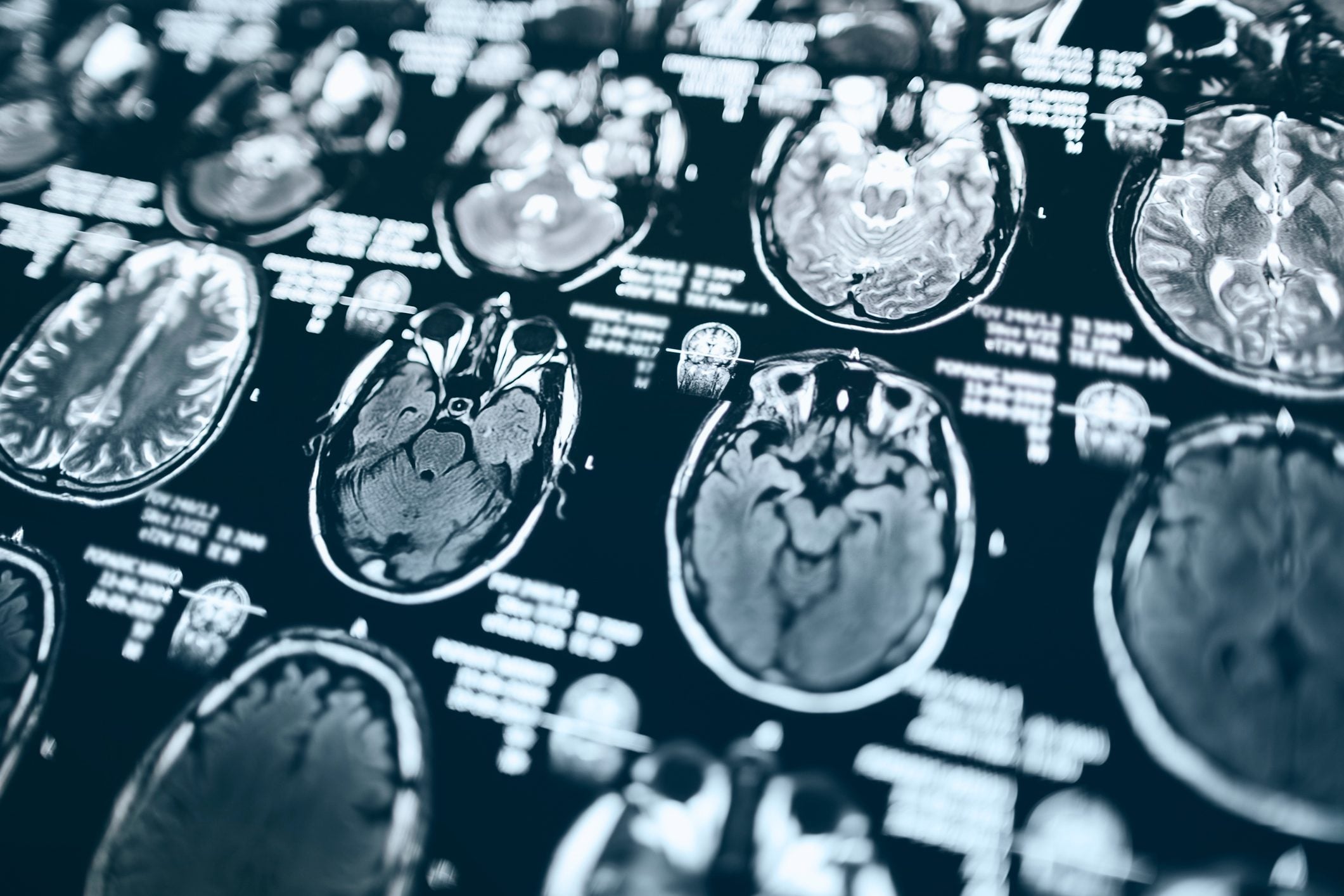 Cleveland Clinic neurologist reveals the #1 habit to help prevent brain ...
