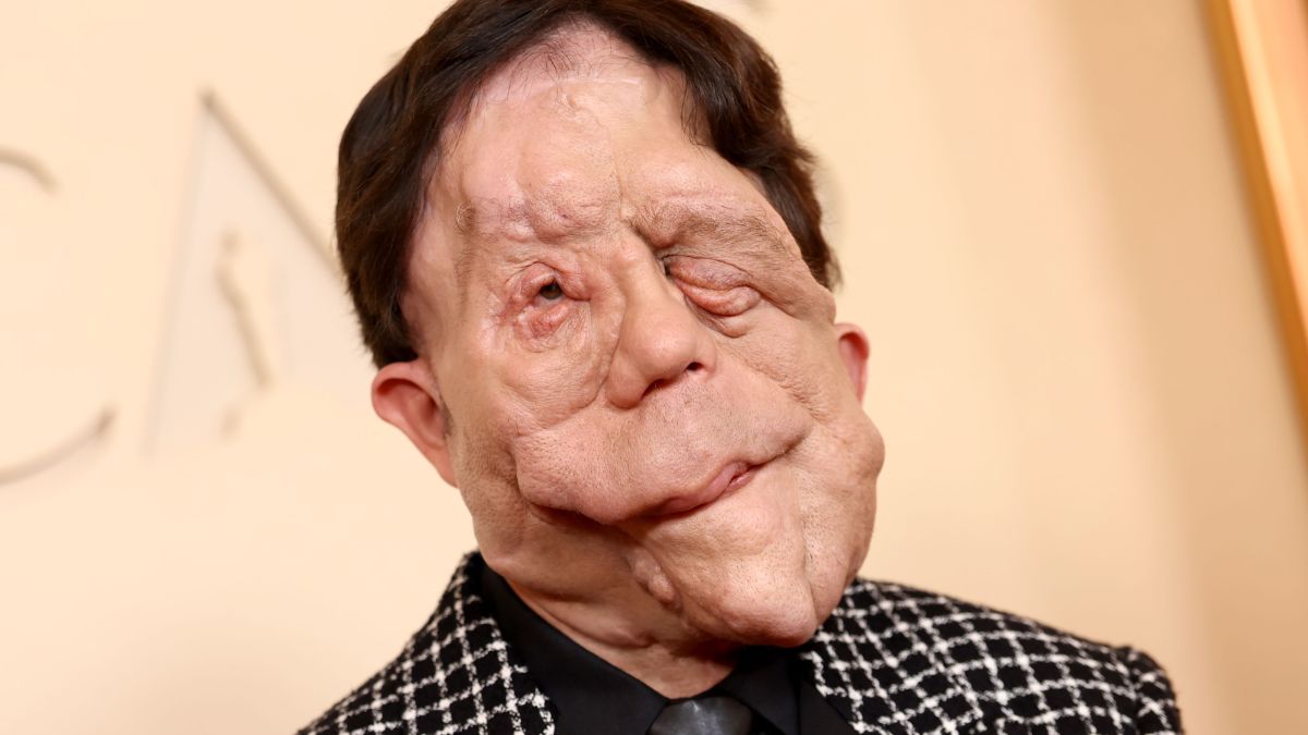 O que é neurofibromatose, condição que afeta o ator Adam Pearson