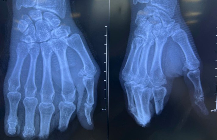 8 tiếng phẫu thuật nối 4 ngón tay đứt lìa