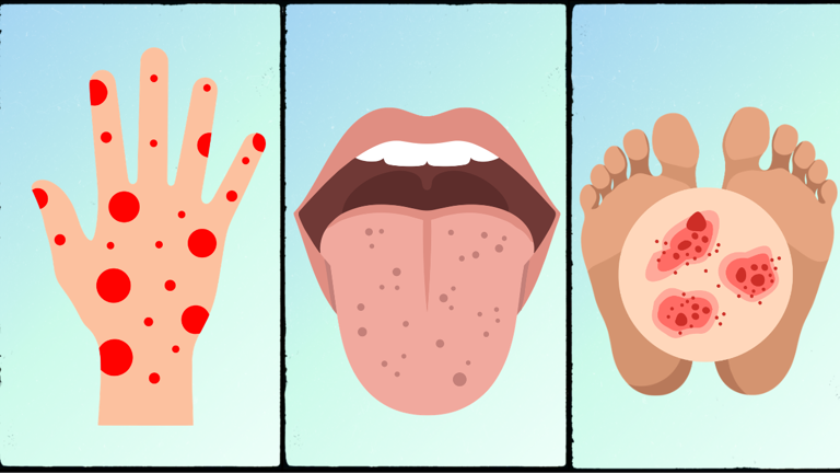 meningitis-outbreak-how-to-differentiate-the-symptoms-from-a-common-rash