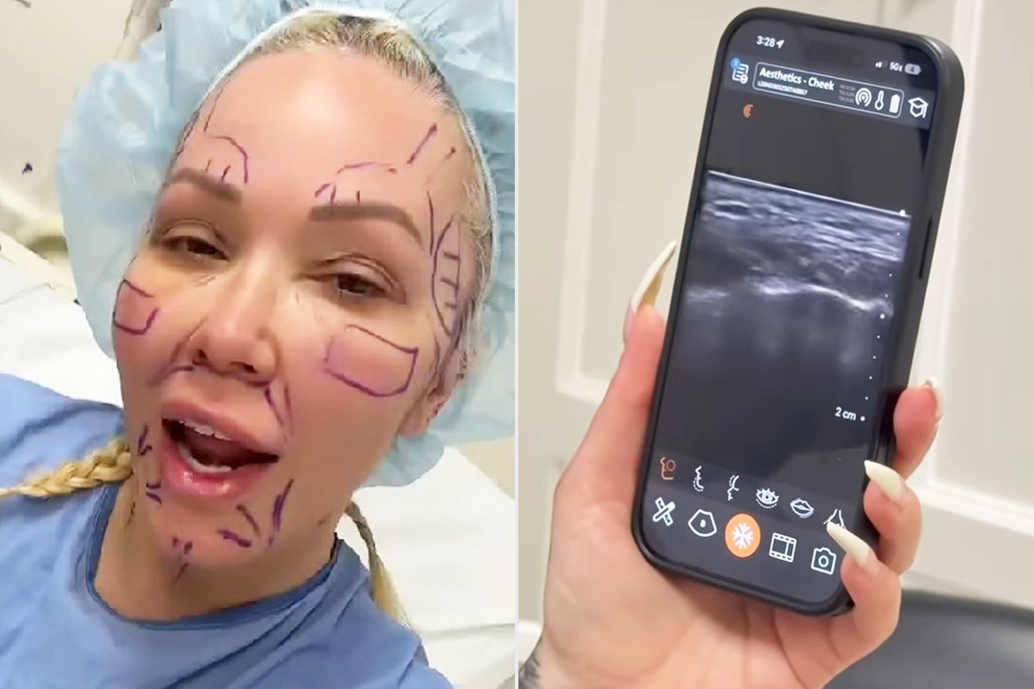 Bunnie Xo reveals she got a facelift at 46 because of 'old filler' that