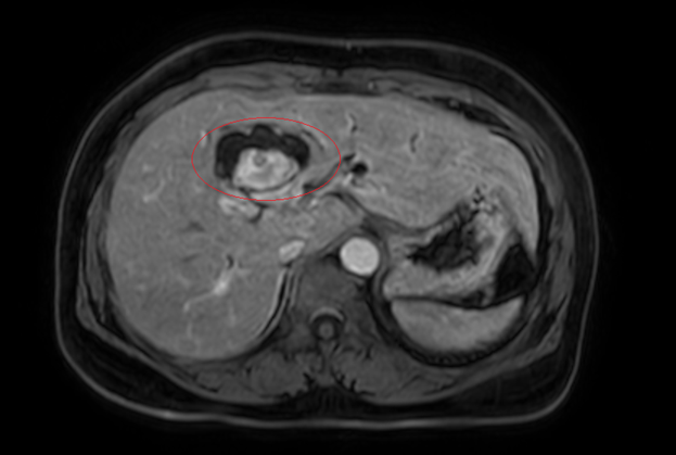 Phát hiện mắc 2 loại ung thư từ triệu chứng vàng da