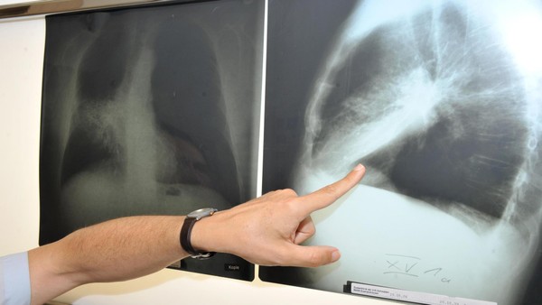 Lungenkrebs-Screening wird Kassenleistung: So kommen Sie an einen Termin