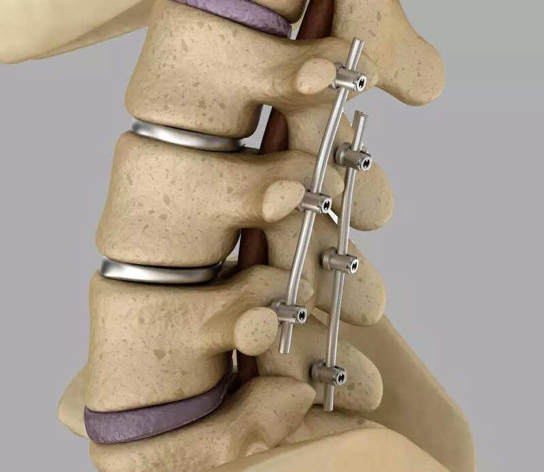 Titanium orthopaedic supply could become a casualty of Gulf crisis