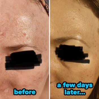 Split image showing skin improvement: left side with acne and blemishes labeled