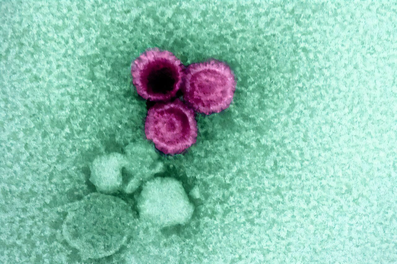 Epstein-Barr virus antibodies can distinguish MS from other ...