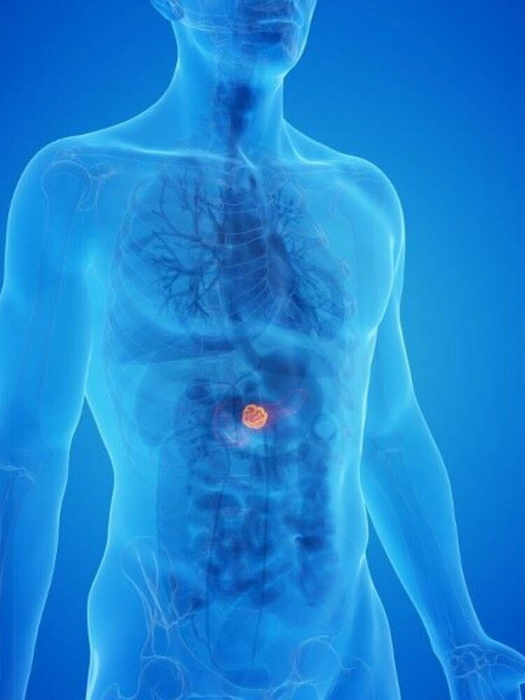 Il tumore al pancreas subdolo e aggressivo, ecco come riconoscerlo