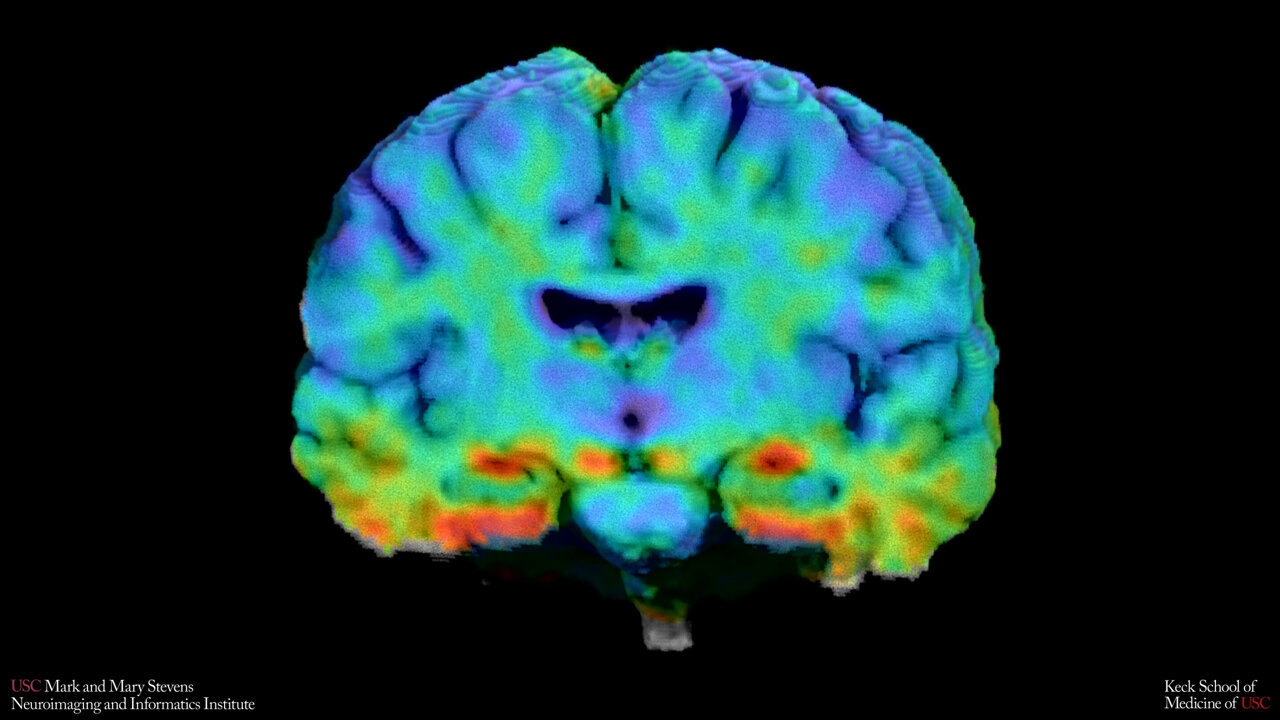 Differences in early Alzheimer's brain markers across diverse ...