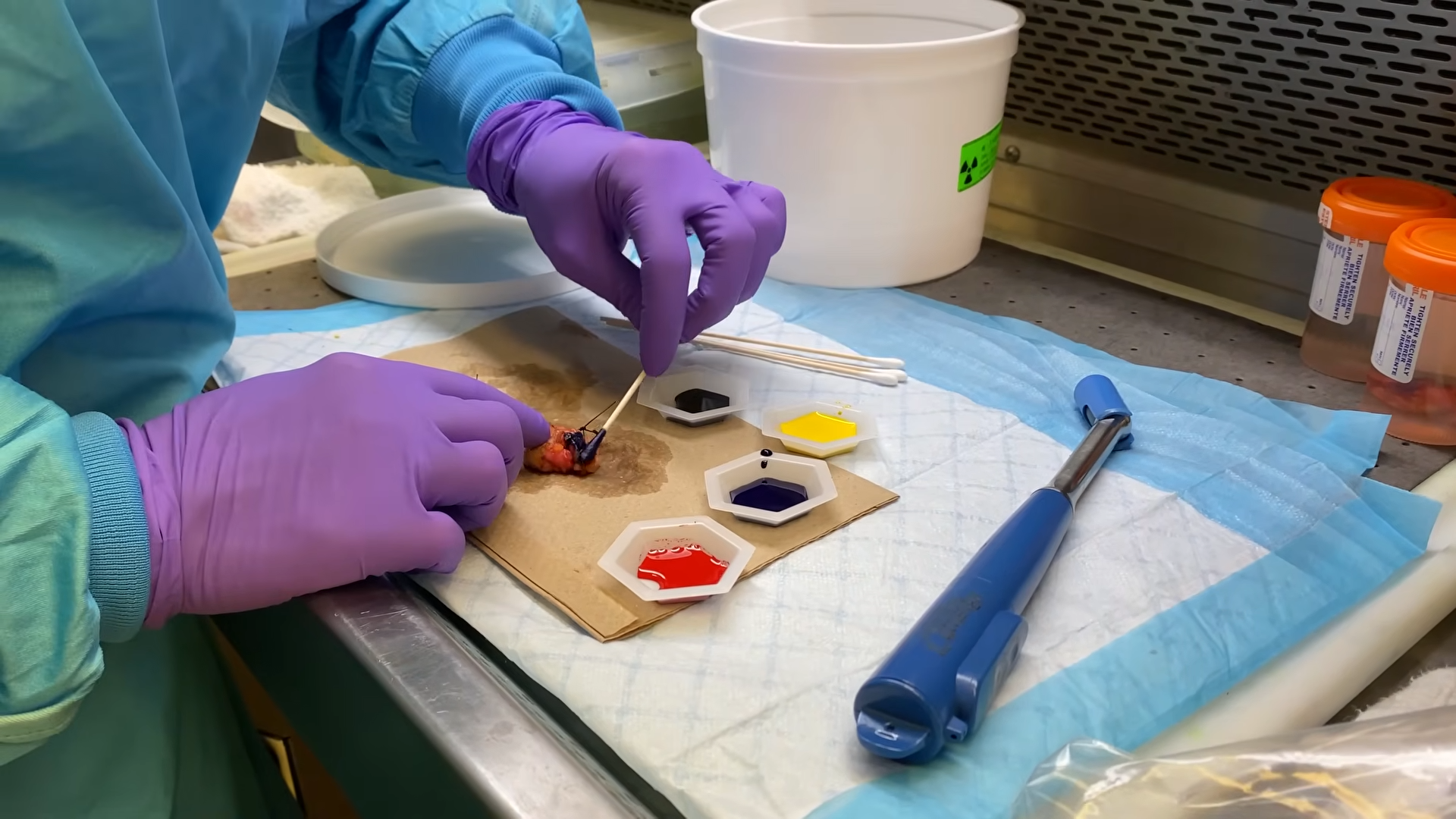 Cancer surgery ends - then pathology begins