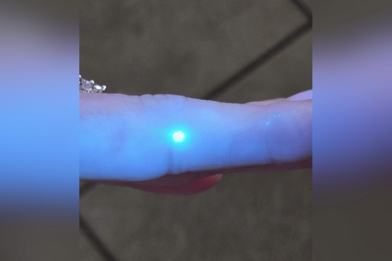 Woman gets spot on finger, shock over what happens under UV light