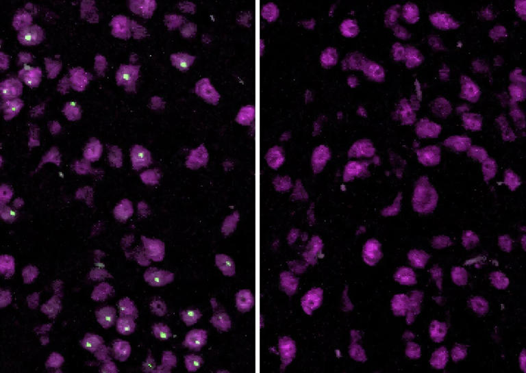 Discovery might inform new approach to Huntington's disease