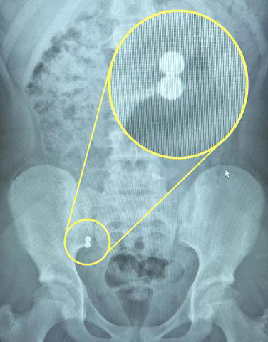 Young girl with special needs swallows magnetic fidget toy that 'ripped ...