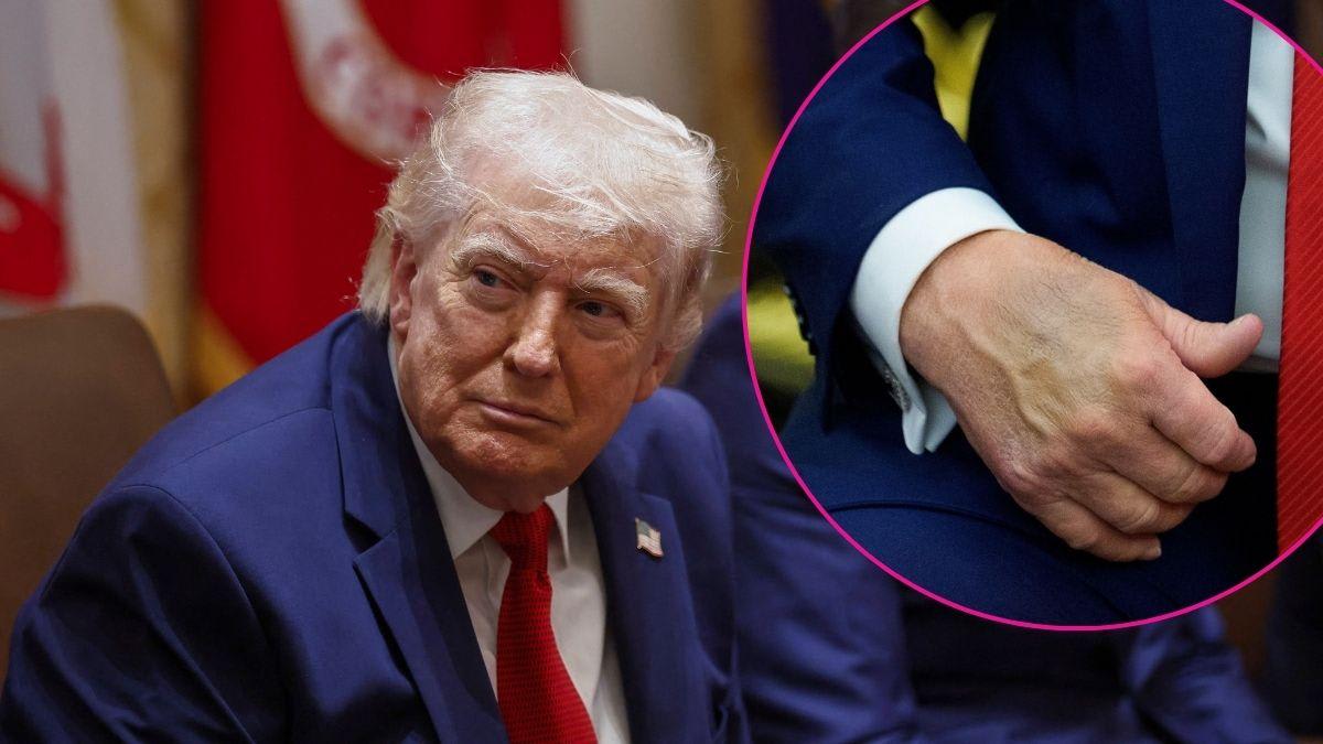 Donald Trump health concerns skyrocket as new insights emerge about ...