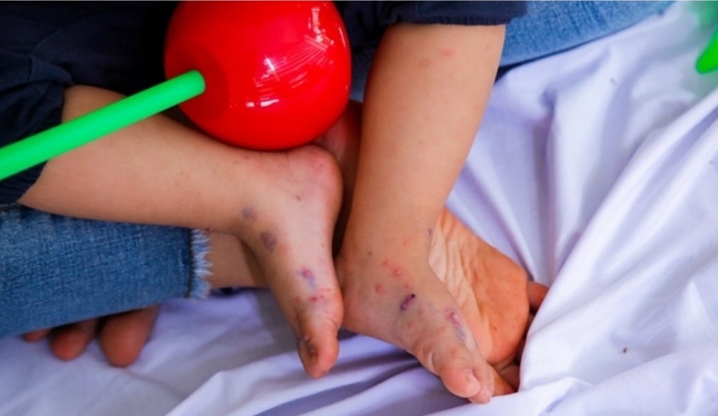 Bệnh tay chân miệng có vaccine chưa?