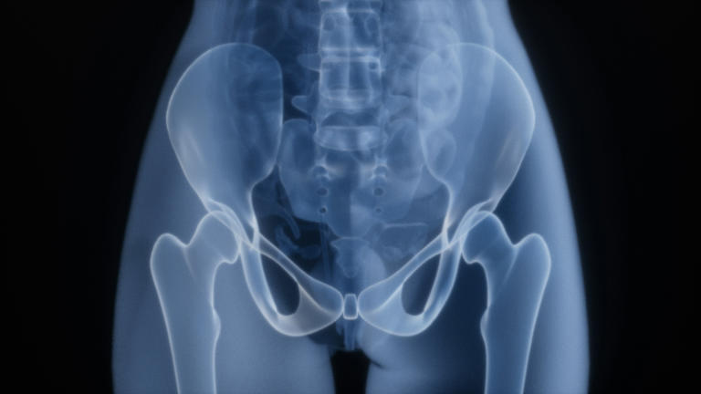 It turns out prunes could help to protect your hips as you age