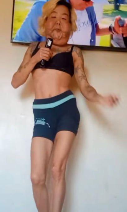 Influencer que quedó desfigurada tras cirugía fallida vuelve al quirófano para nueva intervención estética