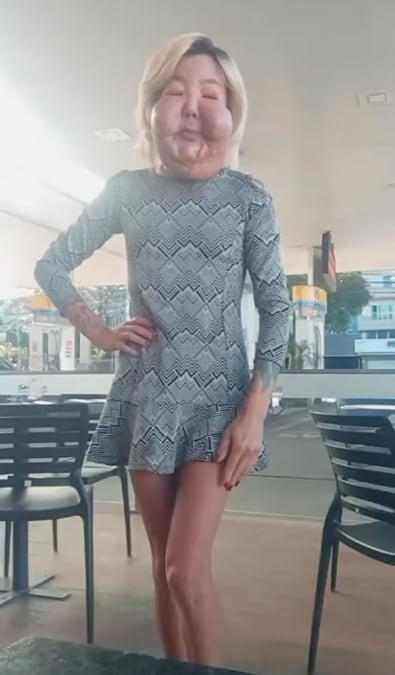 Influencer que quedó desfigurada tras cirugía fallida vuelve al quirófano para nueva intervención estética