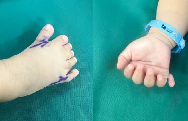 「決して他人事ではない」指が“26本”…乳児に見られた複合奇形、その原因に注目集まる