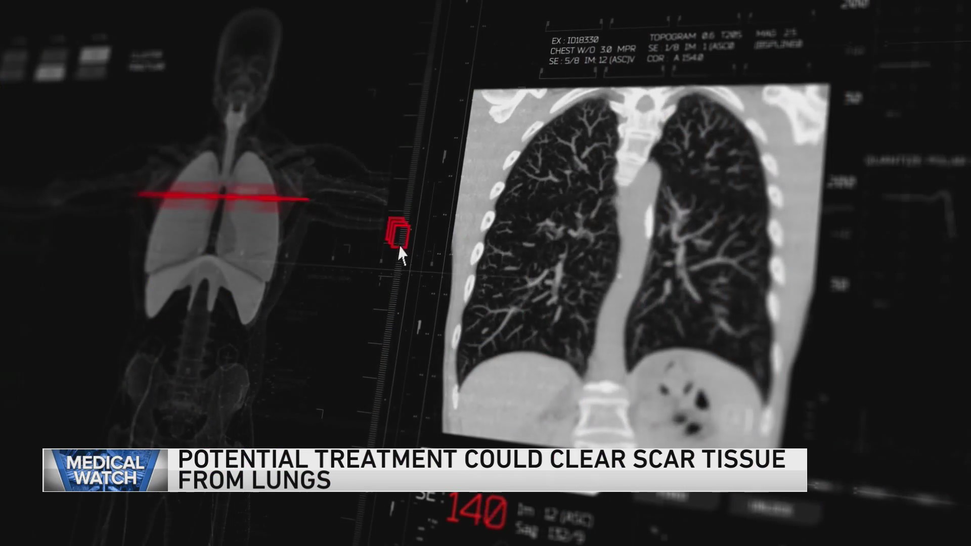 Potential treatment could clear scar tissue from lungs